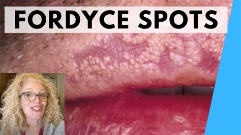 Nov 27, 2017 Symptoms. . Fordyce spots vs warts